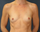 Feel Beautiful - Breast Augmentation Case 58 - Before Photo